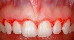 Clínica Dental Nieves Golbano Meléndez dientes con carillas de composite