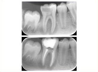 Clínica Dental Nieves Golbano Meléndez endodoncia