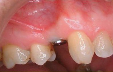 Clínica Dental Nieves Golbano Meléndez coronilla dental