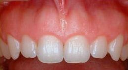 Clínica Dental Nieves Golbano Meléndez dientes blancos con carillas de composite