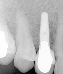 Clínica Dental Nieves Golbano Meléndez implante dental