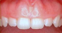 Clínica Dental Nieves Golbano Meléndez carillas de composite